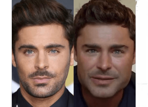 Zac Efron Plastische Chirurgie